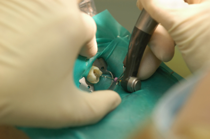 Root Canal